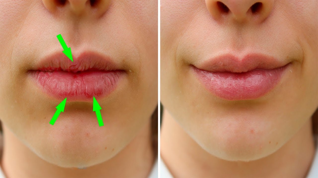 chapped lips treatment